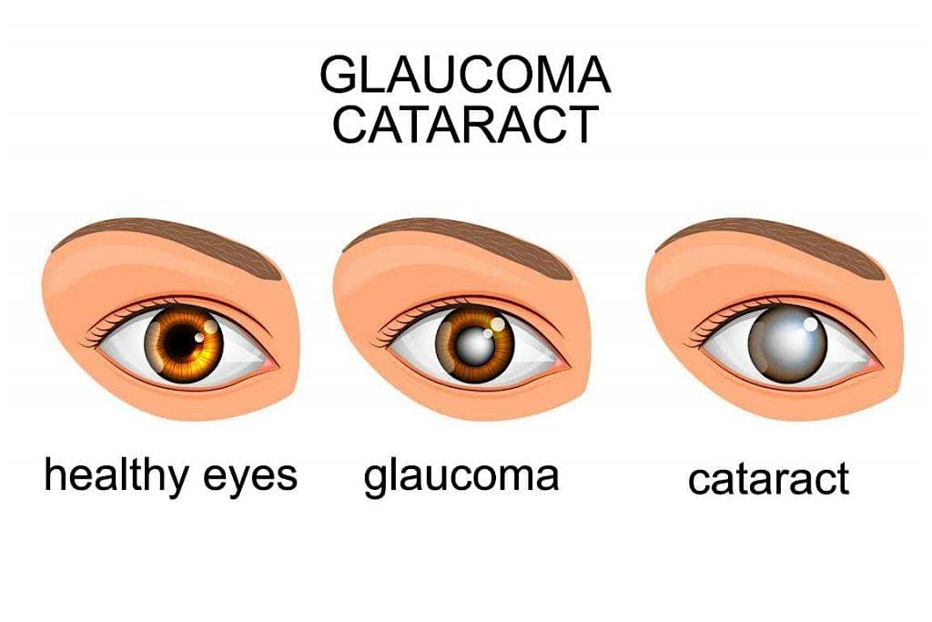 Glaucoma Simplified